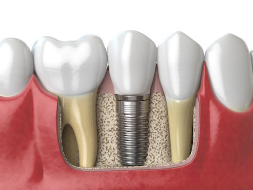 Huntington Dental Group implant